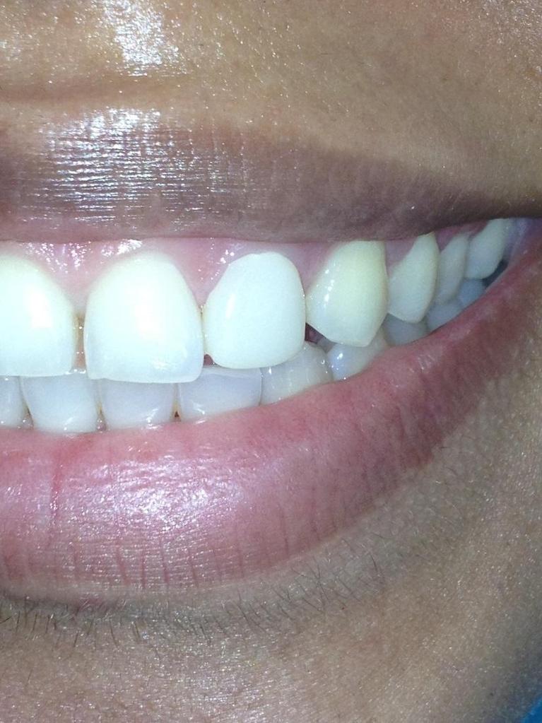 Anterior-Crowns-After-Image