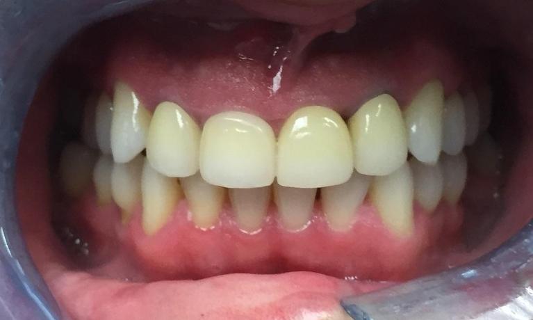 Anterior-Implant-and-Crowns-After-Image