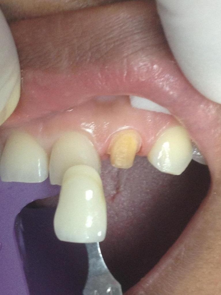 Anterior-Crowns-Before-Image